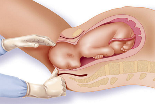 polycystic ovary syndrome