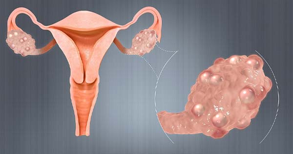 polycystic ovary syndrome