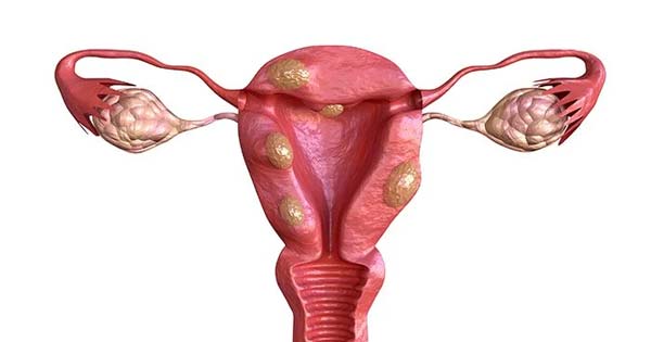 uterine fibroids